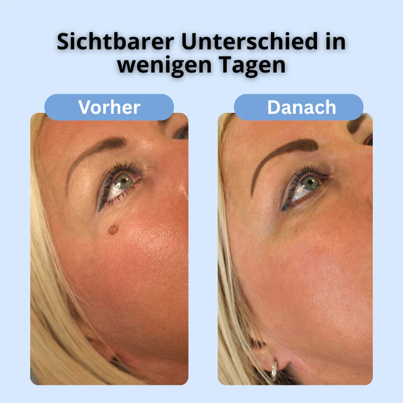 TagAway™ Kit – Glatte Haut in 5 Tagen