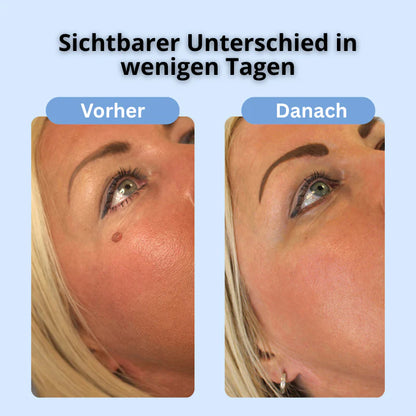 TagAway™ Kit – Glatte Haut in 5 Tagen